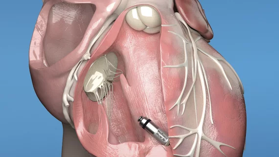 Flash Mysterieus afvoer Medtronic's next-generation leadless pacemakers gain FDA approval