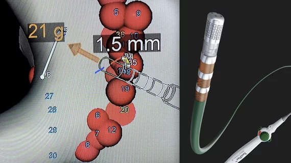 Abbott's TactiFlex flexible tip, force sensing ablation catheter (right), and its integration with the EnSite X EP mapping system (left) showing the distance from the last ablation. and the contact force during an AFib pulmonary vein isolation. 