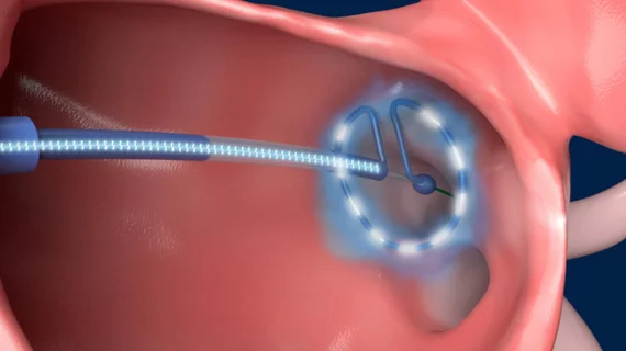 The Medtronic pulsed field ablation (PFA) system.