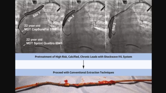 Shockwave Medical's intravascular lithotripsy used during transvenous lead extraction