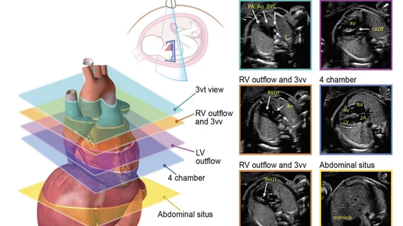 Axial planes suggested for screening the fetal heart at the time of the obstetric anatomic survey and as an initial series obtained during fetal echocardiography. #Fetalecho
