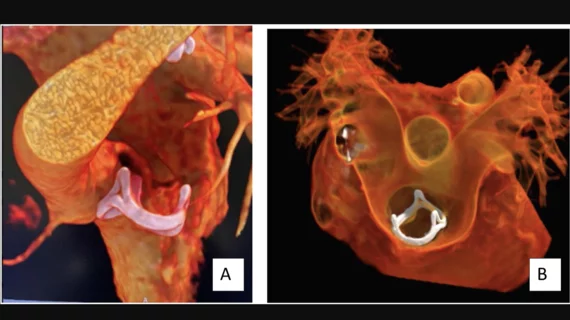 Image of a bioprosthetic valve within the RVOT from the SCCT's congenital heart disease guidelines