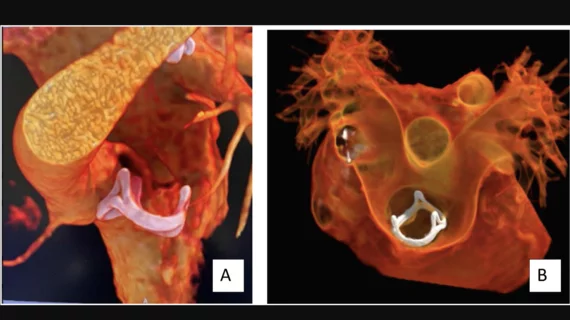 Image of a bioprosthetic valve within the RVOT from the SCCT's congenital heart disease guidelines
