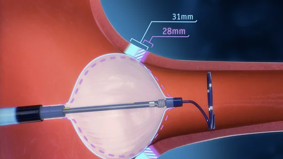Boston Scientific’s POLARx Cryoablation System to treat atrial fibrillation gained FDA approval in August 2023. It is compatible with two balloon sizes, 31 and 28 mm to fit different sized anatomies.