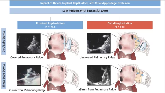 The depth of left atrial appendage occlusion (LAAO) devices inside the LAA impacts outcomes. #LAAO