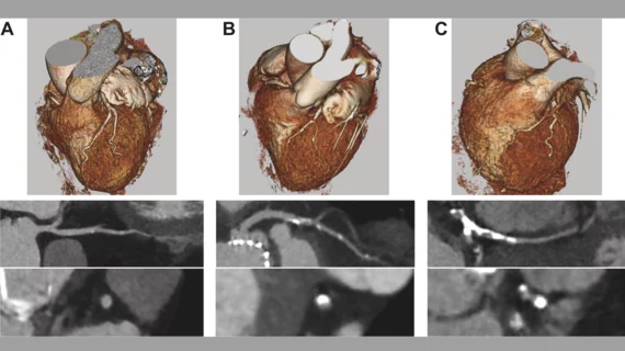CTA images before TAVR to screen for coronary artery disease