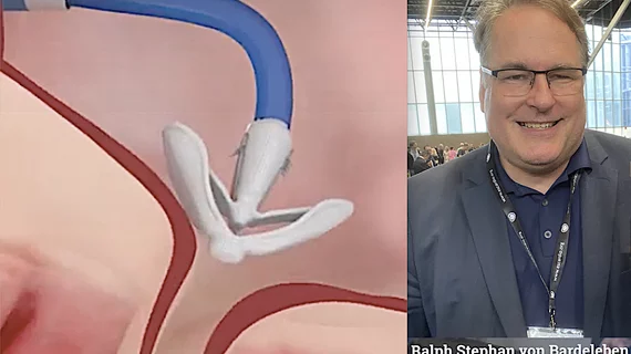 Video of Prof. Dr. Ralph Stephan von Bardeleben explaining the latest details from key tricuspid valve trials.