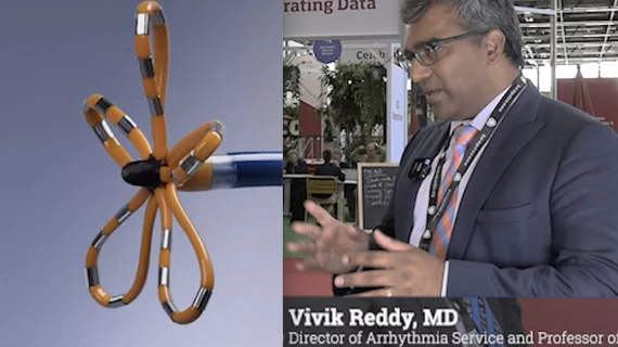 Vivik Reddy, MD, director of arrhythmia service and processor of medicine in cardiac electrophysiology, Mt. Sinai, New York, expolains the key takeaways from the ADVENT trial of pulsed field ablation at ESC 2023.