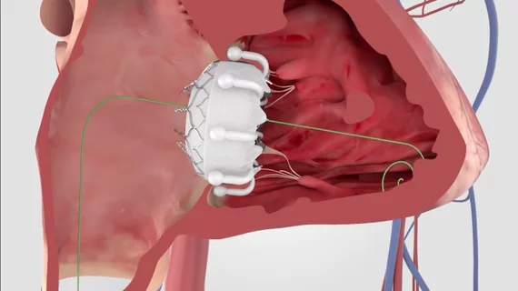 Edwards Evoque transcatheter tricuspid valve replacement TTVR.