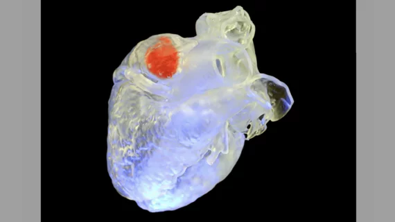 A newly developed 3D printing ink (appearing in red) in a model of a heart can be injected where a structure will be printed and ultrasound will harden the ink into the form. This could be used for future left atrial appendage occlusions. Image courtesy of Zhang et al.