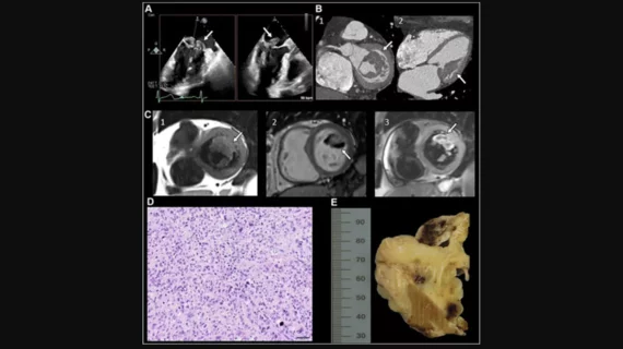 “Undifferentiated Cardiac Sarcoma of the Mitral Valve: Multimodal Imaging Assessment" Radiology: Cardiothoracic Imaging RSNA 