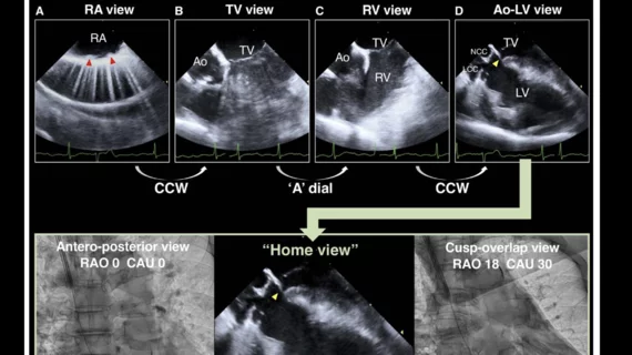 ICE guidance reduces risk of permanent pacemaker implantation after ...