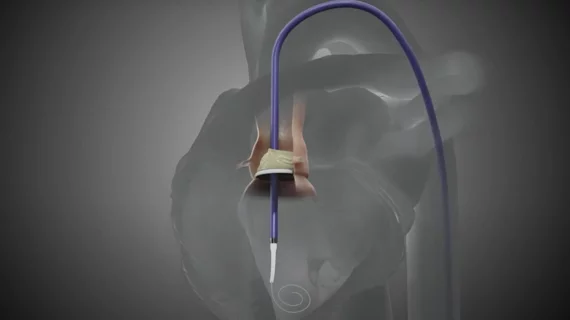 Pi-Cardia ShortCut TAVR device. Pi-Cardia, an Israeli medtech company, announced that multiple heart teams throughout the United States have now used its ShortCut leaflet modification device to perform successful valve-in-valve transcatheter aortic valve replacement (TAVR) procedures. 