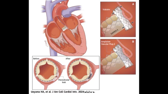 Overview of the Tootsie Roll technique for treating paravalvular leak in certain transcatheter heart valve patients. Tootsie Roll paravalvular leak transcatheter heart valves.