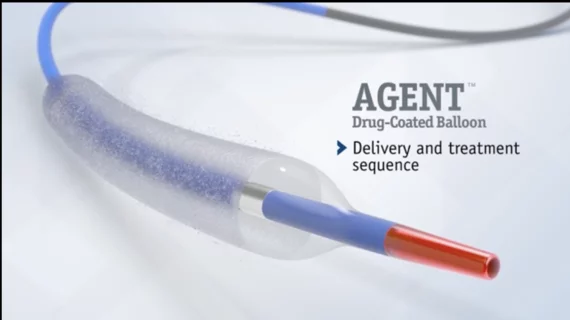 Boston Scientific has received U.S. Food and Drug Administration (FDA) approval for its Agent Drug-Coated Balloon (DCB) for the treatment of coronary in-stent restenosis (ISR) in patients with coronary artery disease. 
