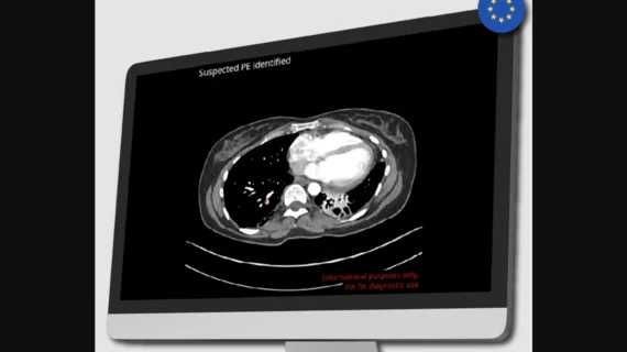 Avicenna.AI, a French artificial intelligence (AI) startup co-founded by a radiologist, has received U.S. Food and Drug Administration (FDA) clearance for two new offerings designed to automatically identify cardiovascular findings in CT scans, CINA-iPE for pulmonary embolism and CINA-ASPECTS. 