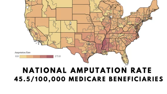 Map of Congressional districts and the rate of amputations based on medicare data showing Mississippi delta region with the highest number of amputation procedures per year. Dr. Fakorede located his practice there to try and combat extremely the high PAD and CLI rates.