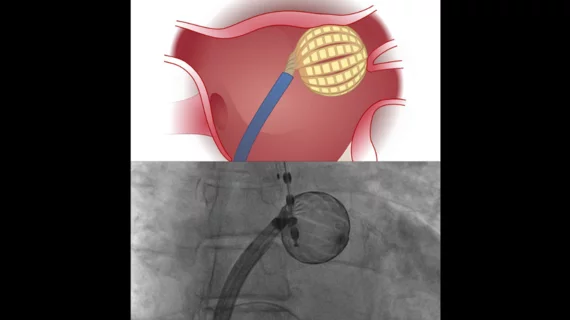 Kardium, a Canadian medical device company focused on electrophysiology technologies, has raised $104 million in new financing. mages of the Globe Pulsed Field System courtesy of Kardium