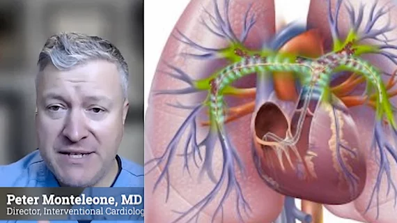 Video interview with Peter Monteleone, MD, explaining the primary catheter-based interventional tools used to treat pulmonary embolism (PE). What are the interventional therapies for pulmonary embolism? Emerging Interventional Therapies for Pulmonary Embolism