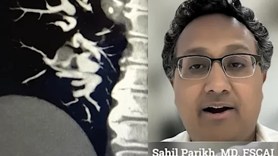 Sahil Parikh, MD, FSCAI, Director of Endovascular Services at New York-Presbyterian Columbia University Irving Medical Center, and Associate Professor of Medicine at the Columbia University College of Physicians and Surgeons, explains there is scant clinical data on what the standard of care should be for pulmonary embolism, so it is up to clinicians to decide what is best for patients based on whether patients have mild to severe PE.