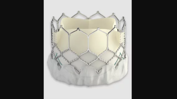 Edwards Lifesciences Sapien 3 transcatheter heart valve used for Mitral Valve-in-Valve