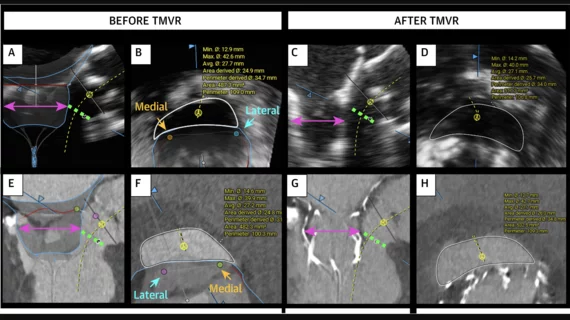 Echocardiography vs CT for Prediction of Newly Created LVOT Area: (A-D) Newly created left ventricular outflow tract (neo-LVOT) assessment by echocardiography and (E-H) CT, both before and after valve implantation. Images courtesy of Bartkowiak et al., JACC: Cardiovascular Imaging.