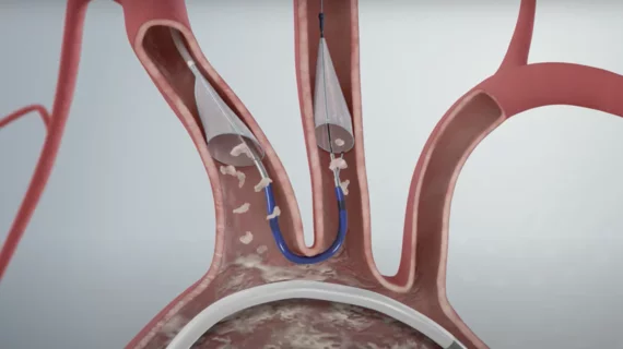 Boston Scientific's Sentinel Cerebral Protection System during a TAVR procedure prevents emboli released from going to the brain and causing a stroke.