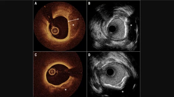 Images coronary calcium imaging by optical coherence tomography (OCT) and high-definition intravascular ultrasound (IVUS). 