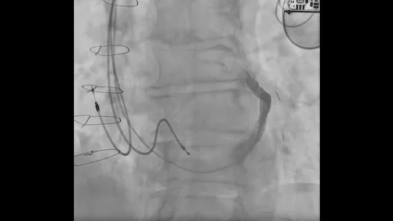 Interventional cardiologists in Canada have performed the world’s first implant of a new coronary sinus reducer designed to treat chest pain patients who see no benefits from other available interventional or surgical treatments. The A-Flux Reducer System was designed and developed by VahatiCor, a new medical device company associated with California-based T45 Labs. 