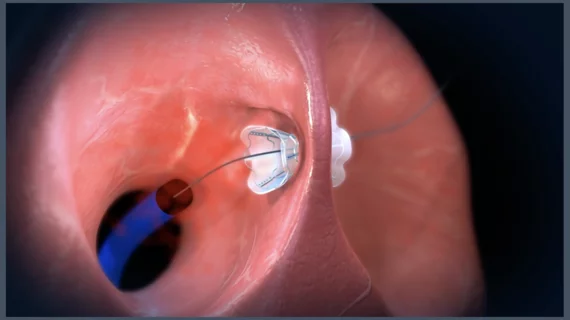 V-Wave has gained considerable attention or its Ventura Interatrial Shunt System, a small implantable device designed to reduce pressure on the left atrium and the lungs in patients with heart failure with reduced ejection fraction (HFrEF). The Ventura device includes a nitinol hourglass-shaped frame that anchors to the patient’s fossa ovalis in a way that prevents migration or embolization. It is implanted via an interventional procedure with fluoroscopy and echocardiography guidance. 