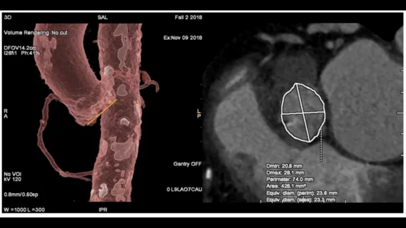 TAVR planning software with GE Healthcare's Valve Assist 2 technology. 