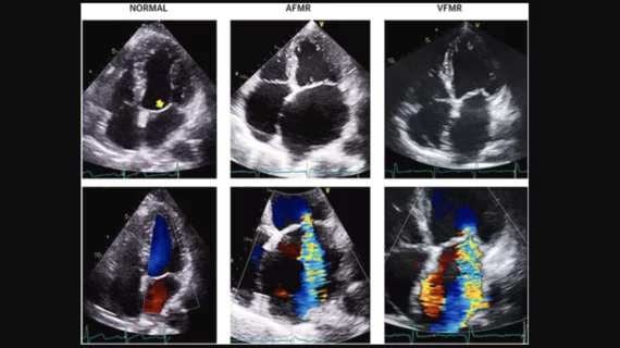 Treating atrial functional mitral regurgitation (AFMR) with surgery may be more beneficial than medical therapy alone, according to new data published in JAMA Network Open.[1]