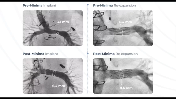 Renata Medical, a California-based healthcare technology company, has gained U.S. Food and Drug Administration (FDA) approval for a new stent specifically designed for pediatric patients with congenital heart defects. The Minima Growth Stent was built to treat newborns, infants and young children, and then it continues to expand as the patient ages