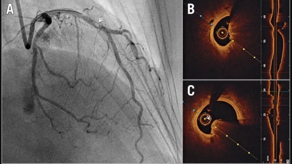 OCT-guided PCI, or optical coherence tomography-guided percutaneous coronary intervention. Optical coherence tomography-guided percutaneous coronary intervention on a calcific protruding nodule. A) Angiography shows a mid-left anterior descending (LAD) nodular obstruction (arrowhead). B) Optical coherence tomography (OCT) imaging reveals a small minimal lumen area and (C) confirms the aetiology of the obstruction to be a calcific protruding nodule (arrowhead). Images courtesy of EuroIntervention 