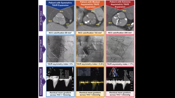 Balloon-expandable transcatheter aortic valve replacement (TAVR) valves that fail to expand symmetrically may be associated with worse hemodynamic data, according to a new analysis published in JACC: Cardiovascular Interventions.