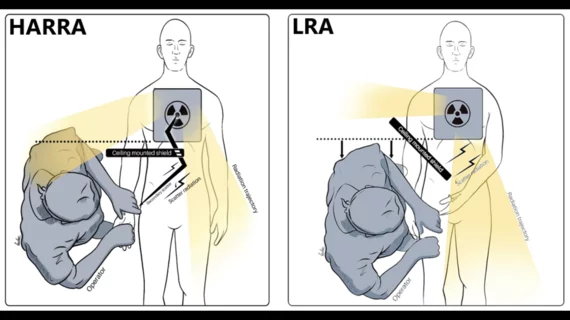 Using a left radial artery (LRA) vs. hyper-adducted right radial artery (HARRA) approach in the cath lab