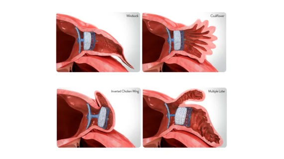 Amplatzer Amulet Left Atrial Appendage Occluder (LAAO) from Abbott 