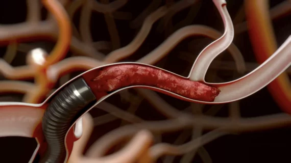 Perfuze Millipede 088 catheter