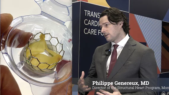 Philippe Genereux, MD, director of the structural heart program at Morristown Medical Center, principal investigator of the late-breaking EARLY TAVR trial, presented new data at ACC 2025 showing intervening earlier on patients with asymptomatic severe aortic stenosis leads to better outcomes. 