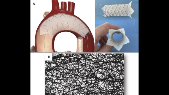 A closer look at world’s first TAVR patient treated with new cerebral ...