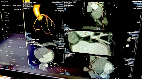  The Society of Cardiovascular Computed Tomography (SCCT) this week released a new expert consensus document on interpretation and reporting of coronary CT angiography (CCTA). The update replaced the 2014 guidance and incorporates advances in scanner technology, image reconstruction, plaque assessment and revised standardized reporting incorporating CAD-RADS 2.0. Image in Philips booth at RSNA 2025, photo by Dave Fornell.