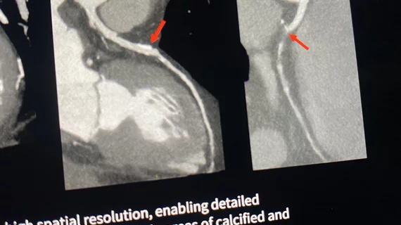 An example of the image quality from the new GE Photonova photon-counting CT system, where more detailed images of soft plaque and the ability to see through heavy calcium and stents is expected to improve CT-FFR assessments.