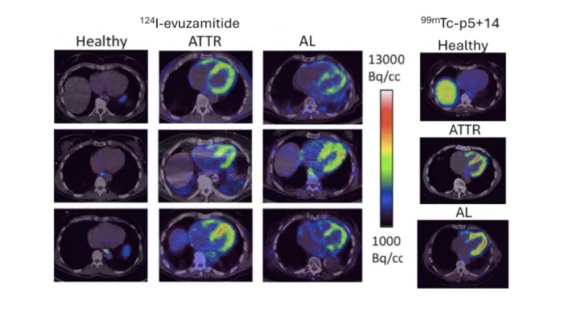 Bayer expands into molecular imaging with cardiac amyloidosis tracer ...