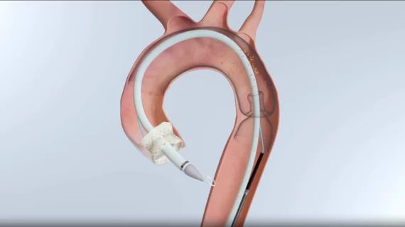 Emboliner® Embolic Protection System