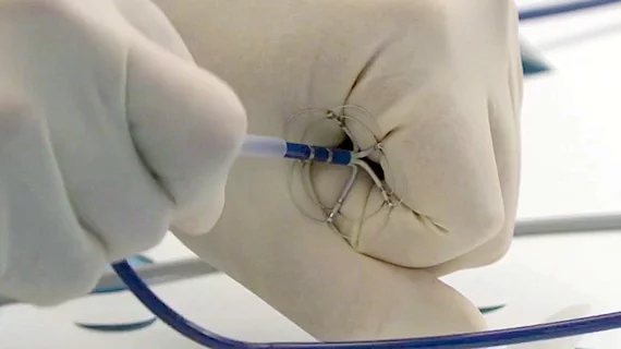 Pulse Biosciences nPulse nanosecond pulsed field ablation (nsPFA) system uses 5‑second applications to create lesions and does not require catheter repositioning.