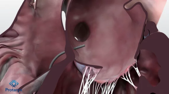 FDA clears next-gen device for left-heart access