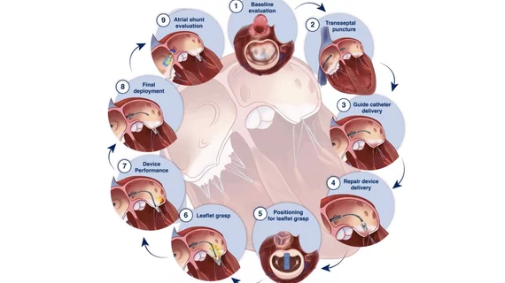 ASE guidelines summary of recommended imaging steps for performance of M-TEER.