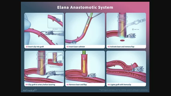 Distal anastomoses are almost exclusively hand-sewn as a current standard of care, which limits the widespread implementation of less-invasive approaches. This trial looked at the ability of the ELANA device to more easily construct distal anastomoses in CABG.