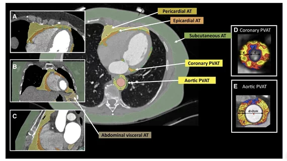Caristo's FAI imaging AI is FDA-cleared for the detection of inflammation in cocornary arteries, but resrach is also looking at its use in detecting the cause of AFib and heart failure. Image courtesy of the European Heart Journal