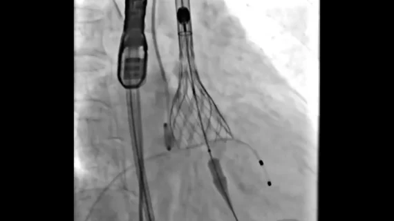 The NCPI-plus TAVR technique